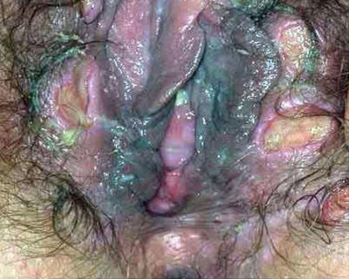 blue waffle vag