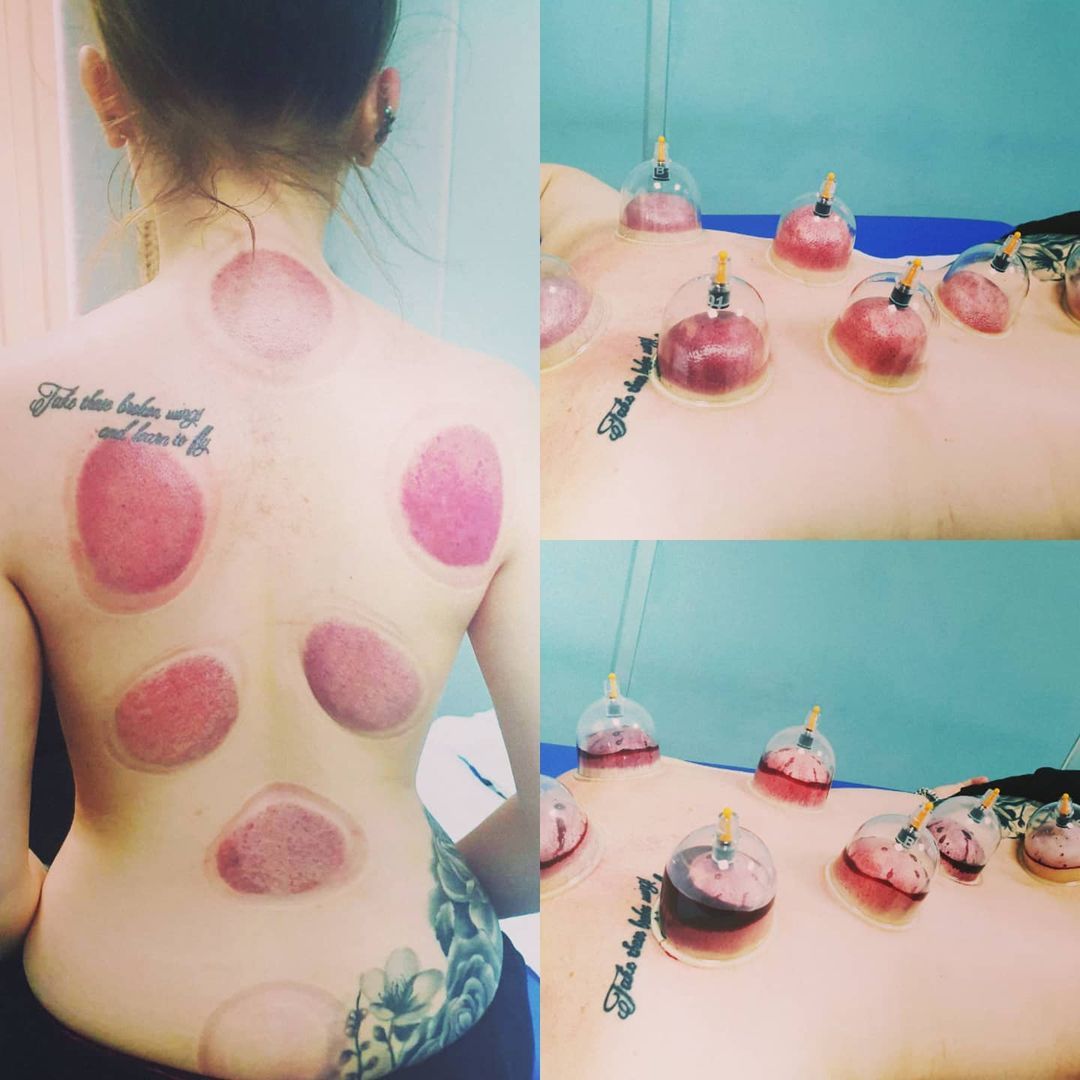 hijama near me