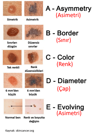 yüzdeki ben ingilizce