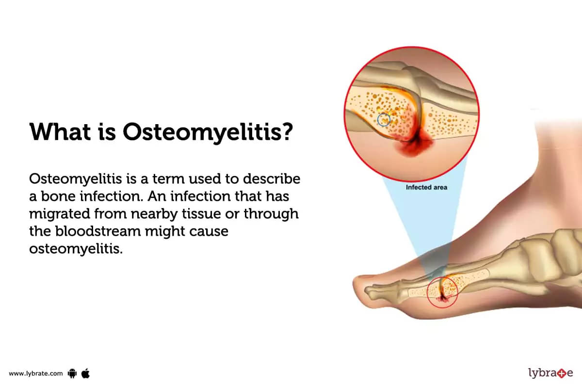 osteomyelitis meaning in tamil