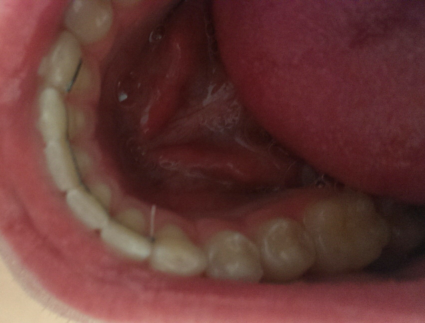 toothbrush bristle stuck in throat