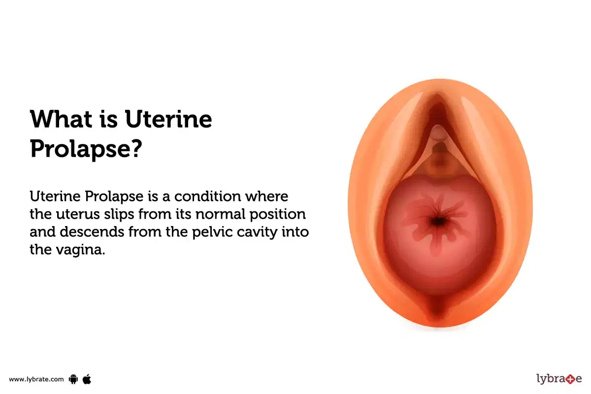 prolapse meaning in telugu