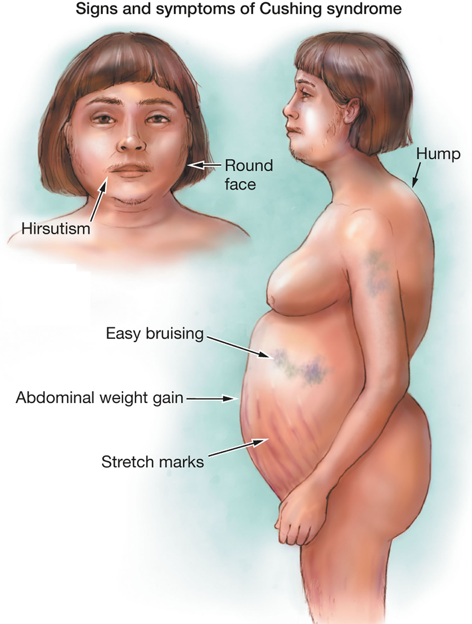 is cushing syndrome treatable