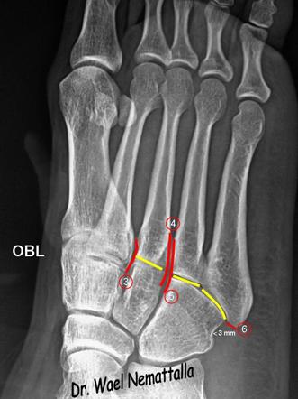 lisfranc fracture radiology