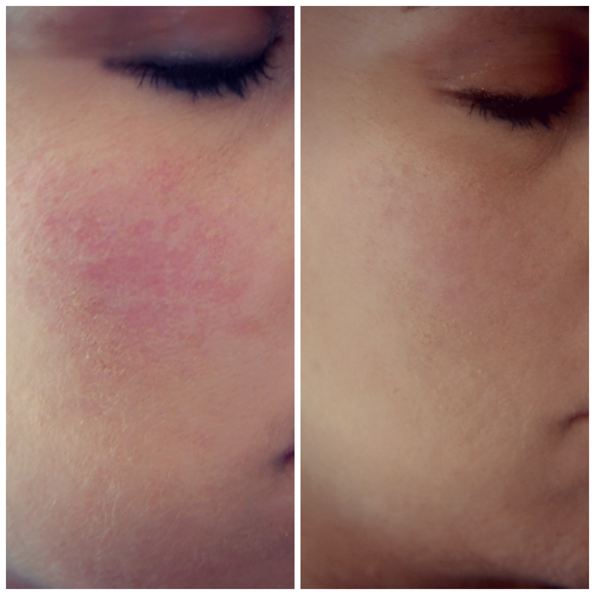 prosacea reviews for rosacea