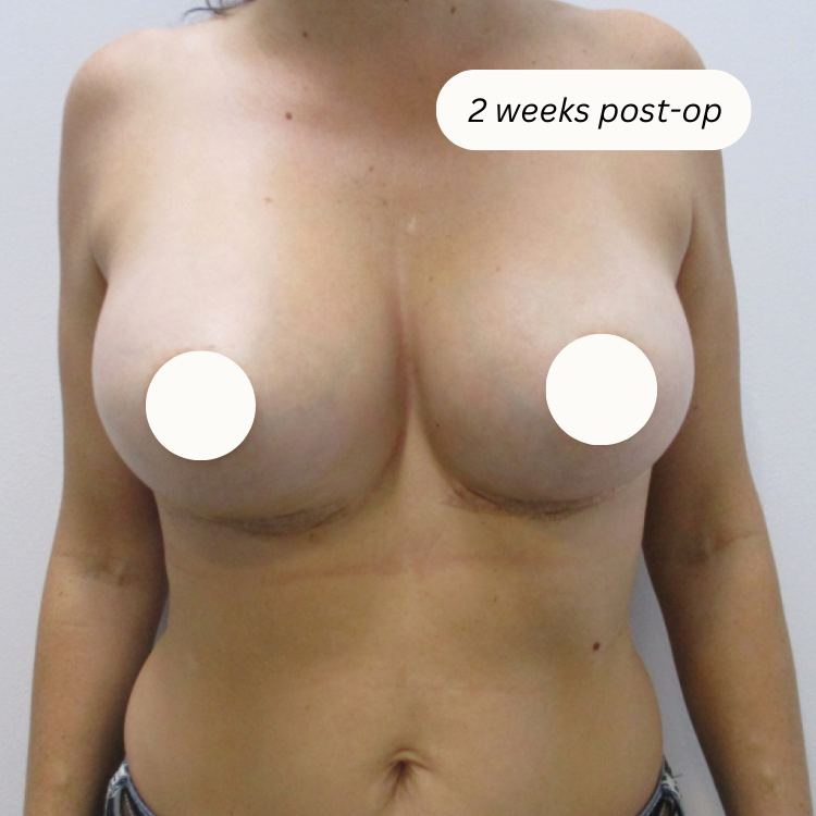 breast implants townsville