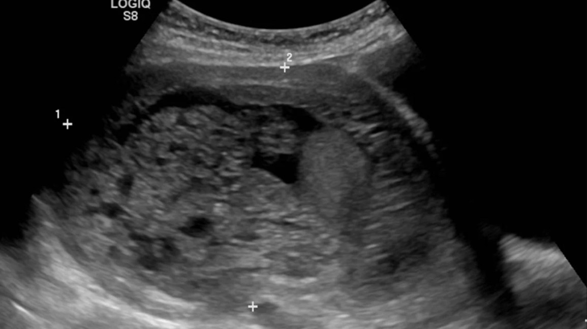 molar pregnancy radiology