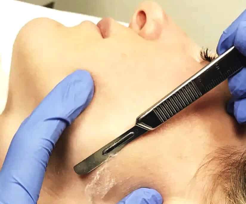 dermaplaning montreal