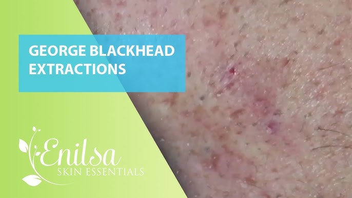 enilsa blackheads