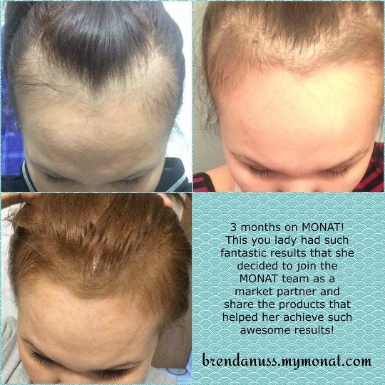 monat for hair loss