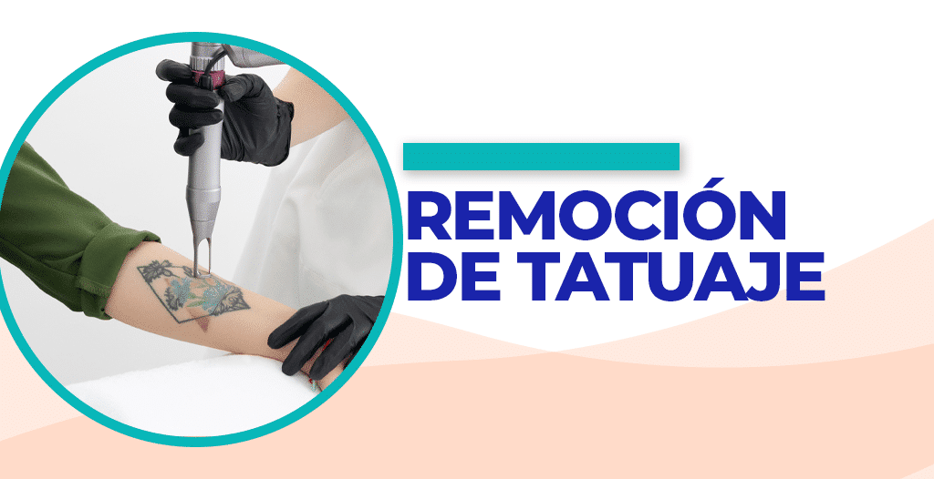 clinica para borrar tatuajes en los olivos