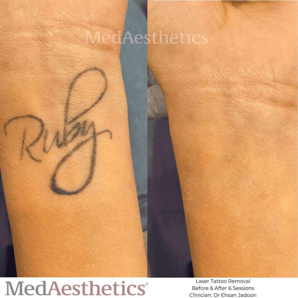 tattoo removal rockingham