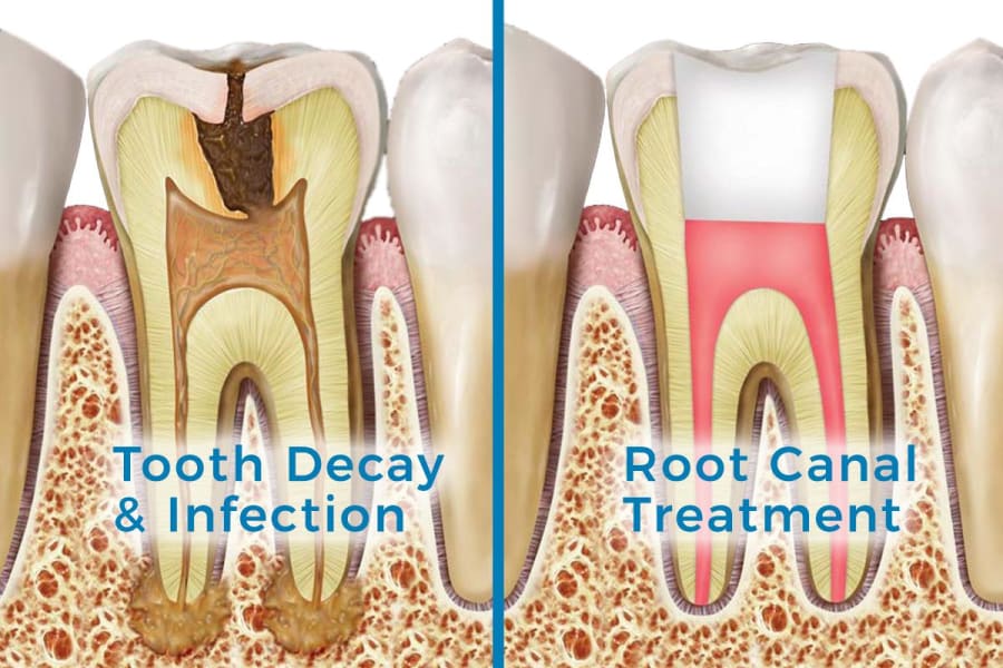 dental root canals treatment maple ridge