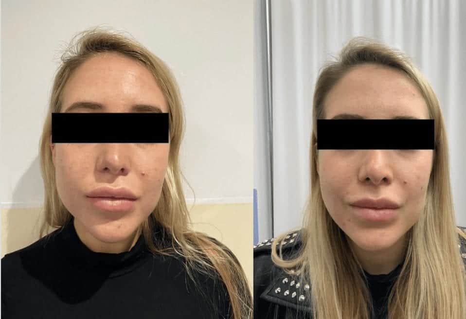 buccal fat removal manchester