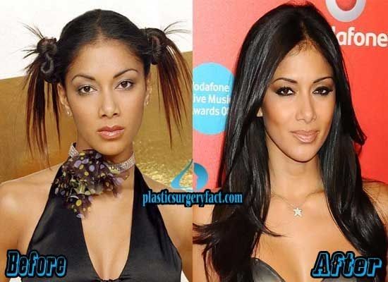 nicole scherzinger breast implants