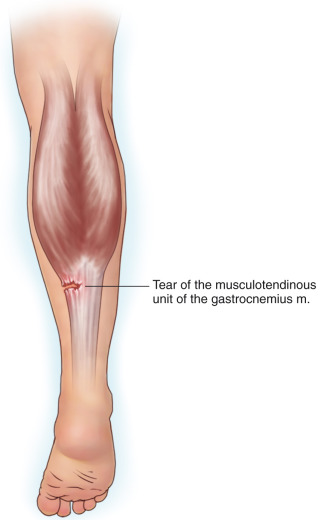 gastrocnemius tear icd 10