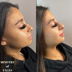 non surgical rhinoplasty leeds