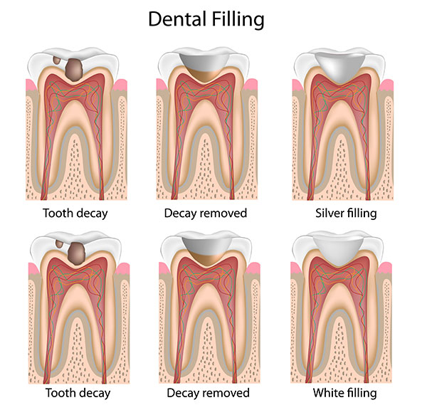 dental cavity filling treatment for kids maple ridge