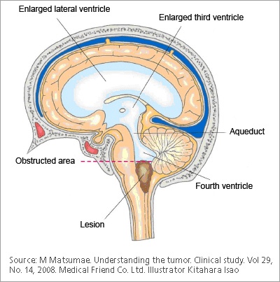 cerebral aqueduct stenosis