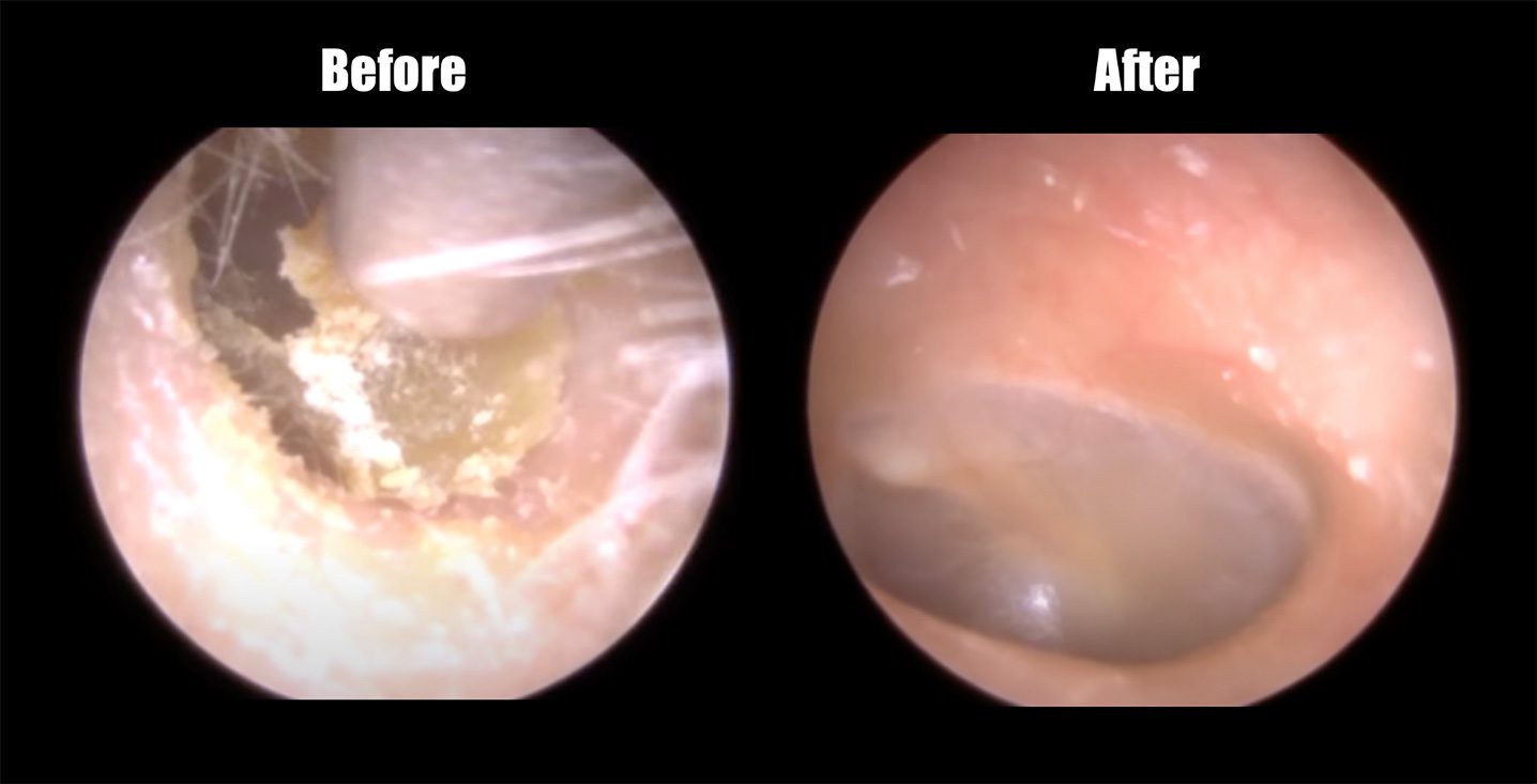 ear wax removal san antonio