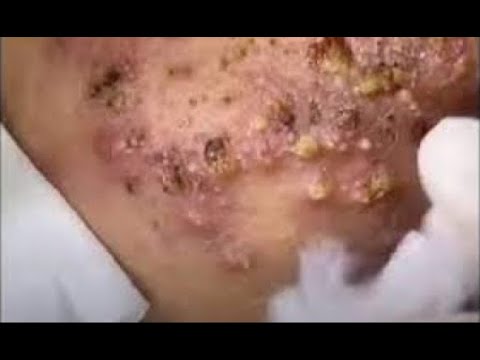 blackhead popping videos 2023