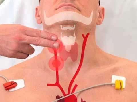 carotid massage for svt