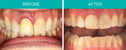 teeth bleaching doncaster east