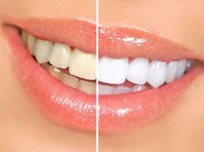 teeth veneer consultation richmond bc