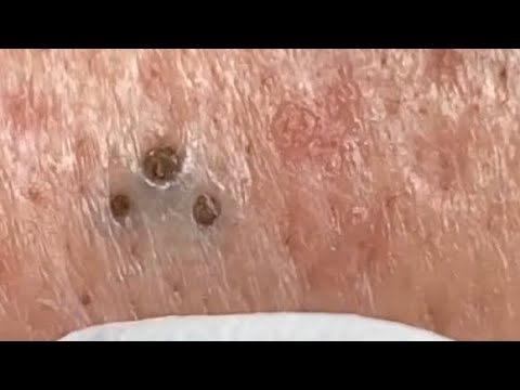 blackheads youtube