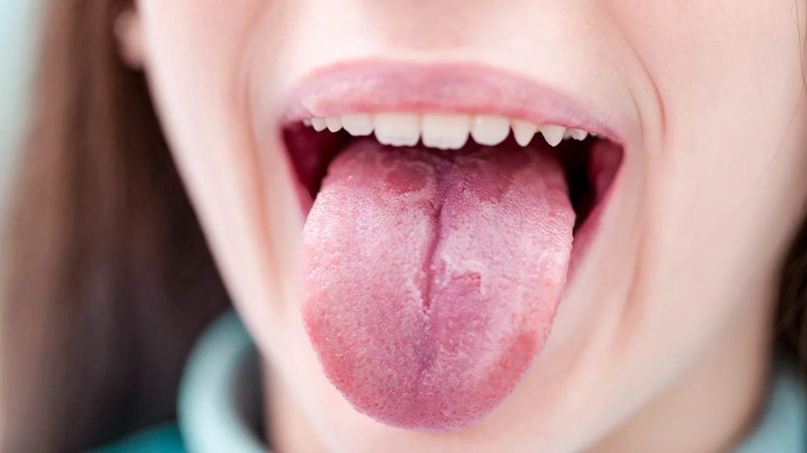 unhealthy tongue pics