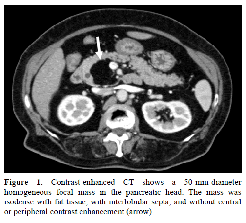 lipoma on pancreas