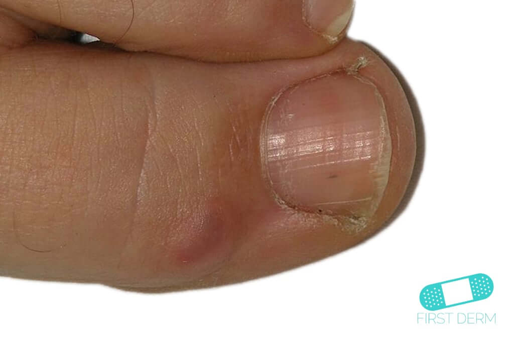 mucous cyst finger icd 10