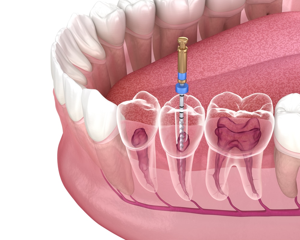 dental root canals services maple ridge