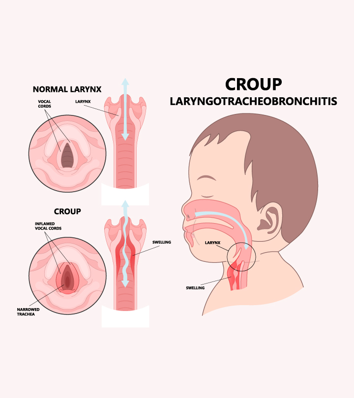 how long is croup contagious nhs