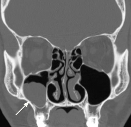 trace mucosal thickening