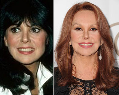 marlo thomas before and after plastic surgery