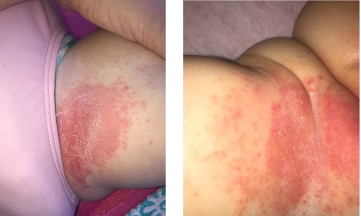 chemical burn from huggies