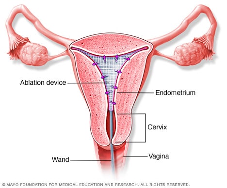 ablación endometrial opiniones