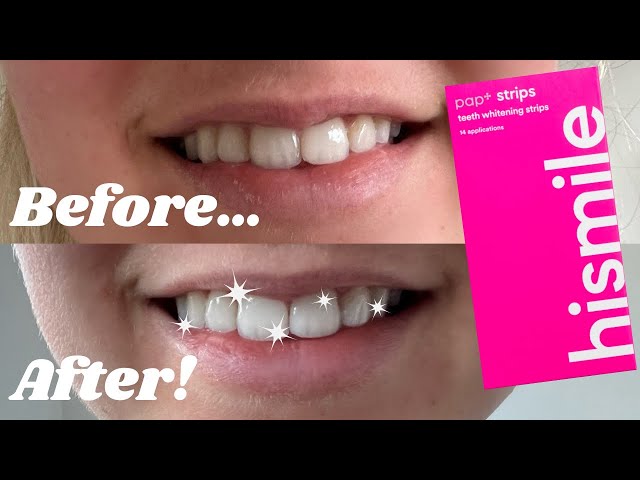 hismile teeth whitening strips reviews