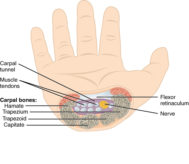 carpal tunnel syndrome wiki