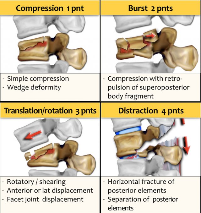 burst fracture radiology