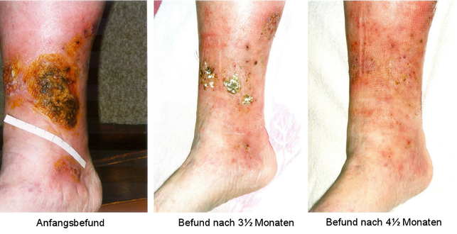 icd 10 venous stasis ulcer right lower leg