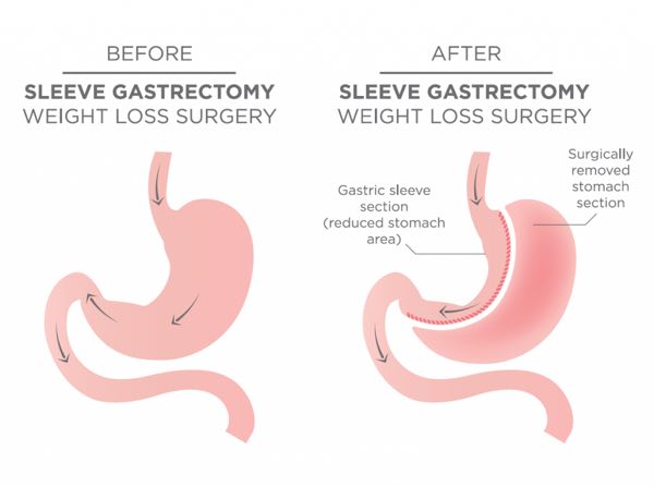 gastric sleeve surgery perth