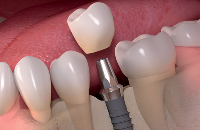 dental implants services maple ridge