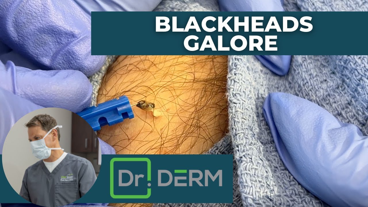 dr derm videos of squeezing blackheads