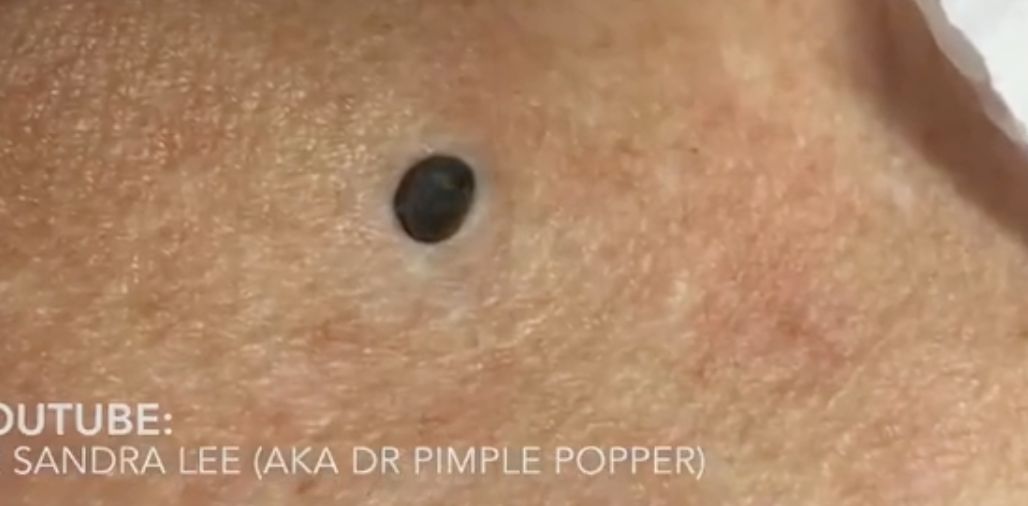 dr pimple popper biggest blackhead