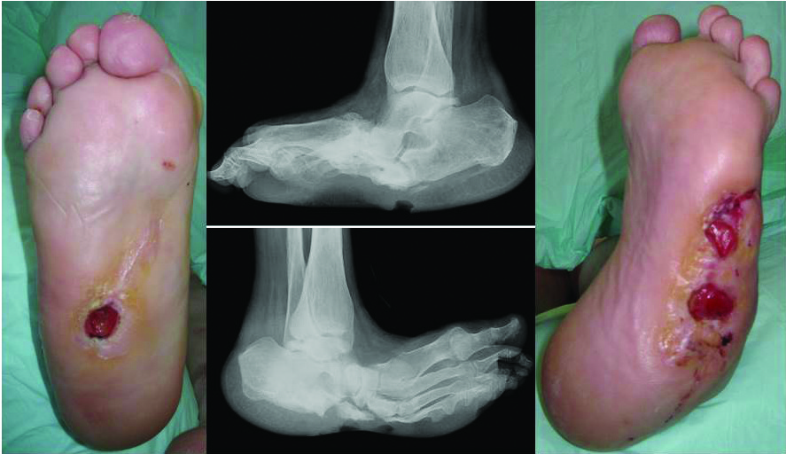 pain in right foot icd 10