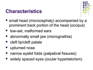 edward syndrome ppt