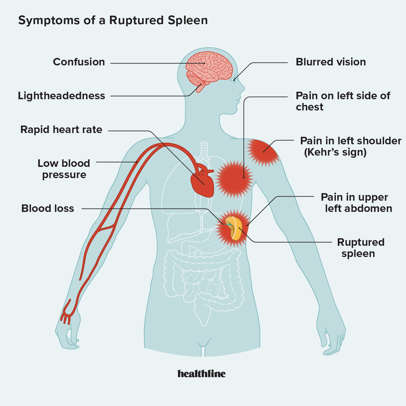 how long can you live with a ruptured spleen