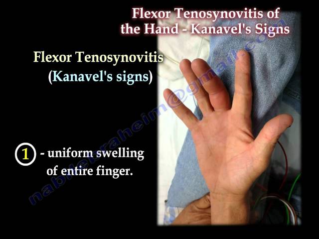 flexor tenosynovitis icd 10